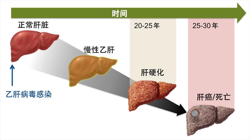乙肝小三阳会传染吗还能活多久,乙肝如果不治疗会怎样