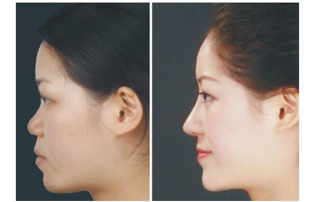 玻尿酸美容的正确方法,玻尿酸又称午餐式美容