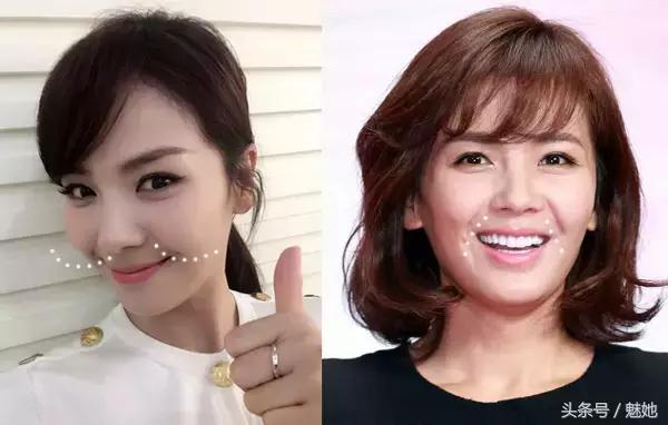 法令纹的种类和改善方法有哪些,法令纹怎么消除4妙招告别衰老