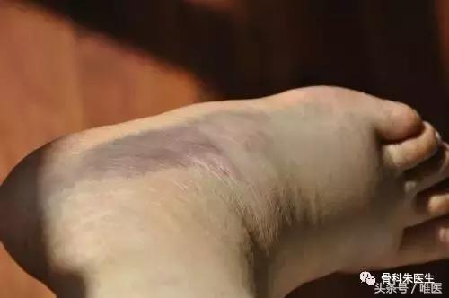 脚踝关节扭伤无骨折怎么恢复快,踝关节扭伤康复治疗注意事项