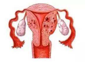 局限性腺肌症怎么治,弥漫性腺肌病做手术会好吗