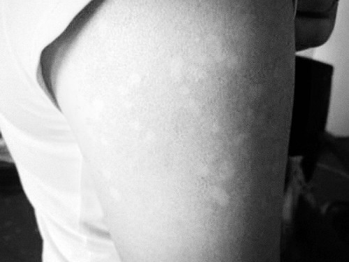 天气热就长黑汗斑,三伏天皮肤发红疹