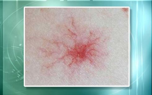 皮肤长小红痣不痛不痒是什么原因,身上长了好多小红痣是什么症状