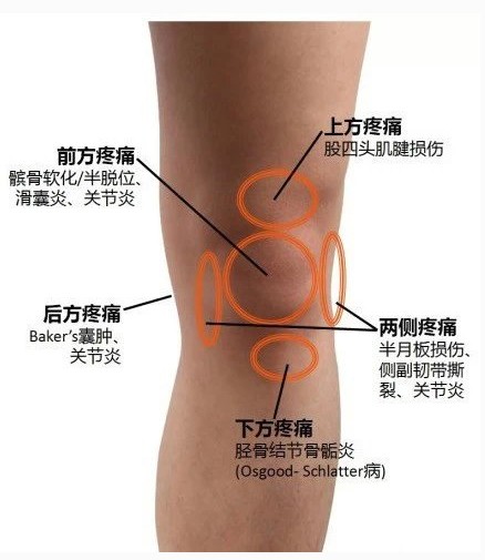 膝盖滑膜炎5天自愈方法,小儿膝盖滑膜炎一般多久能自愈