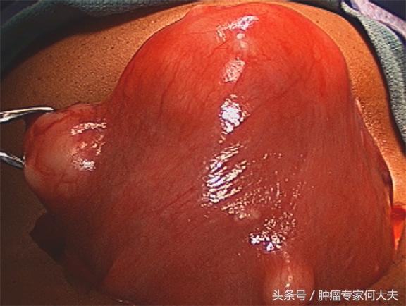 子宫肌瘤腹腔镜手术算大手术吗,子宫肌瘤16mmx13mm要手术吗