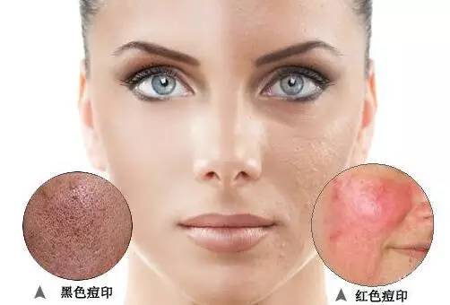 不用祛痘产品怎样祛痘印最有效,教你如何快速祛痘印最有效的方法