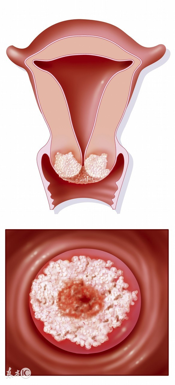 如何发现宫颈肥大,它的症状及病因又是什么