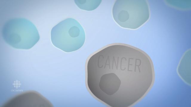 古巴治疗肺癌晚期,古巴肺癌晚期治疗