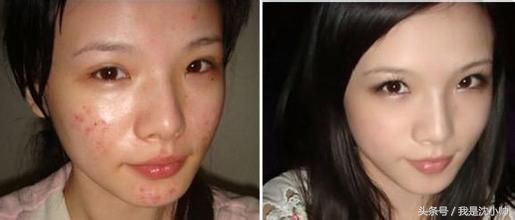 如何祛痘痘印的小窍门简单有效,如何快速祛痘祛痘印小妙招