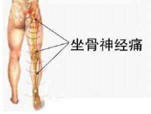 腰椎突出压迫坐骨神经痛怎么治疗,坐骨神经痛单侧屁股痛怎么治疗呢