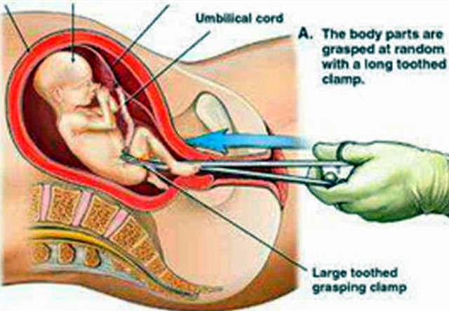 怀孕四个月又是女儿做引产，引产对胎儿到底有多残忍！