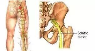 最粗长的针刀治疗女性坐骨神经痛,梨状肌导致的坐骨神经痛怎么治疗