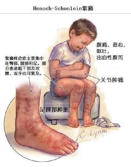 过敏性紫癜发病机制流程图,过敏性紫癜的重要病因病机中医
