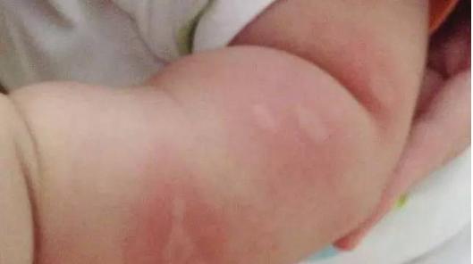 宝宝驱蚊神器,儿童驱蚊特效药