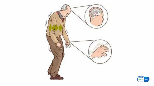 帕金森病人吃普拉克索多久才见效,盐酸普拉克索片是帕金森用药吗