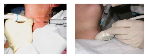 甲状腺超声介入射频疗法,甲状腺超声介入消融术