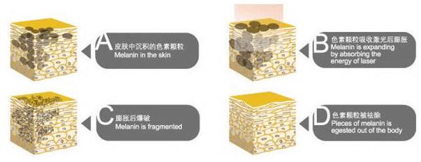 告别鹌鹑颜·美丽从此不一“斑”