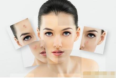 不做激光祛痘怎么去除痘印,不做医美怎么改善痘坑