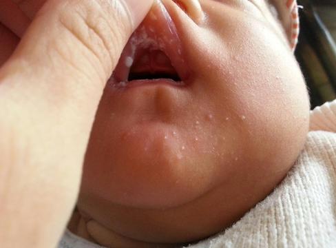 宝宝得了鹅口疮，博士级妈妈竟用外婆的偏方，差点要了孩子的命