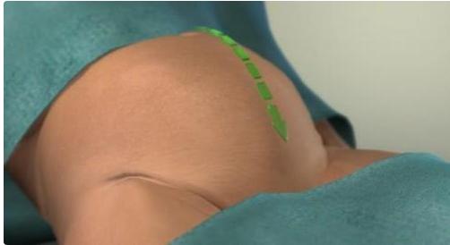 给孩子看的剖腹产手术全部流程,剖腹产手术最详细的介绍