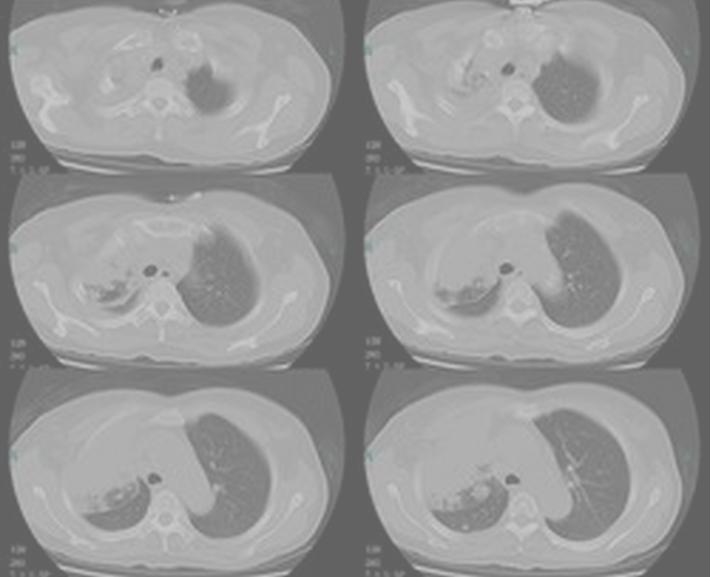 科普：肺癌早期发现分期分型很重要