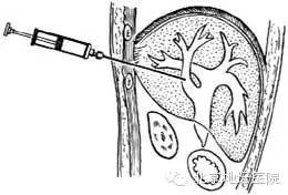 医生强调做肝穿到底是查什么病,医生建议做肝穿就一定要做吗