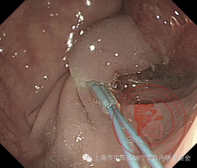 内镜套扎是什么,内镜套扎器械