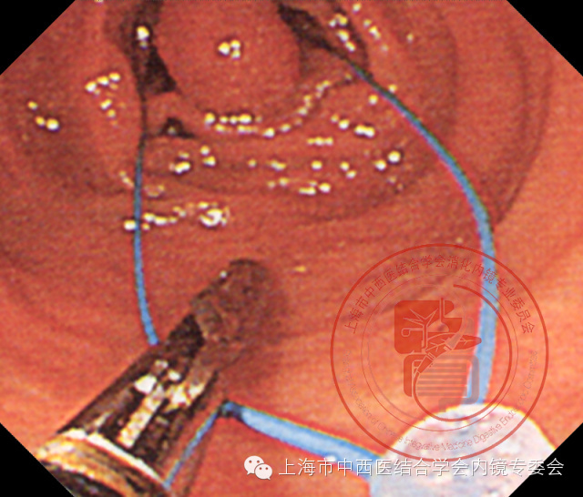 内镜套扎是什么,内镜套扎器械