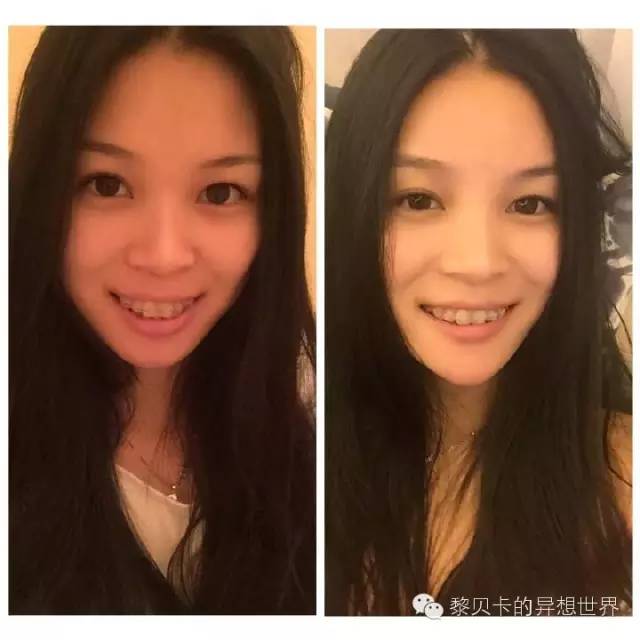 她们说||那些年整牙吞下的血和泪,终于换来最开怀的大笑