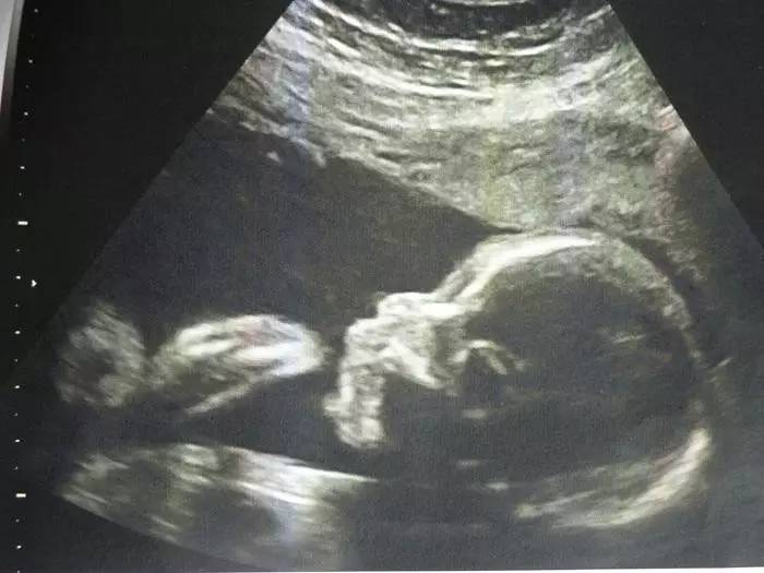 胎儿横位英文缩写,b超单上英文缩写代表什么