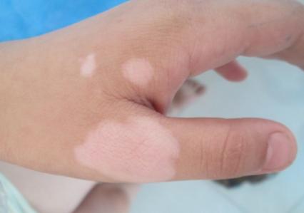 新生儿身上的白斑是怎么回事,新生儿有白斑是怎么回事