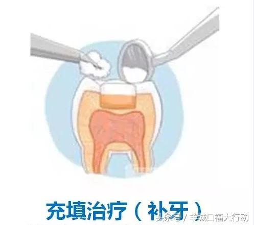 龋齿蛀牙有虫吗,科普蛀牙的形成