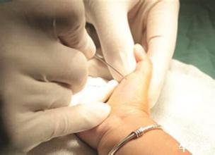 拇指弹响治疗方法,拇指腱鞘炎弹响最快的恢复方法