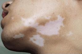 情绪不好出现皮肤病,情绪不稳定得皮肤病