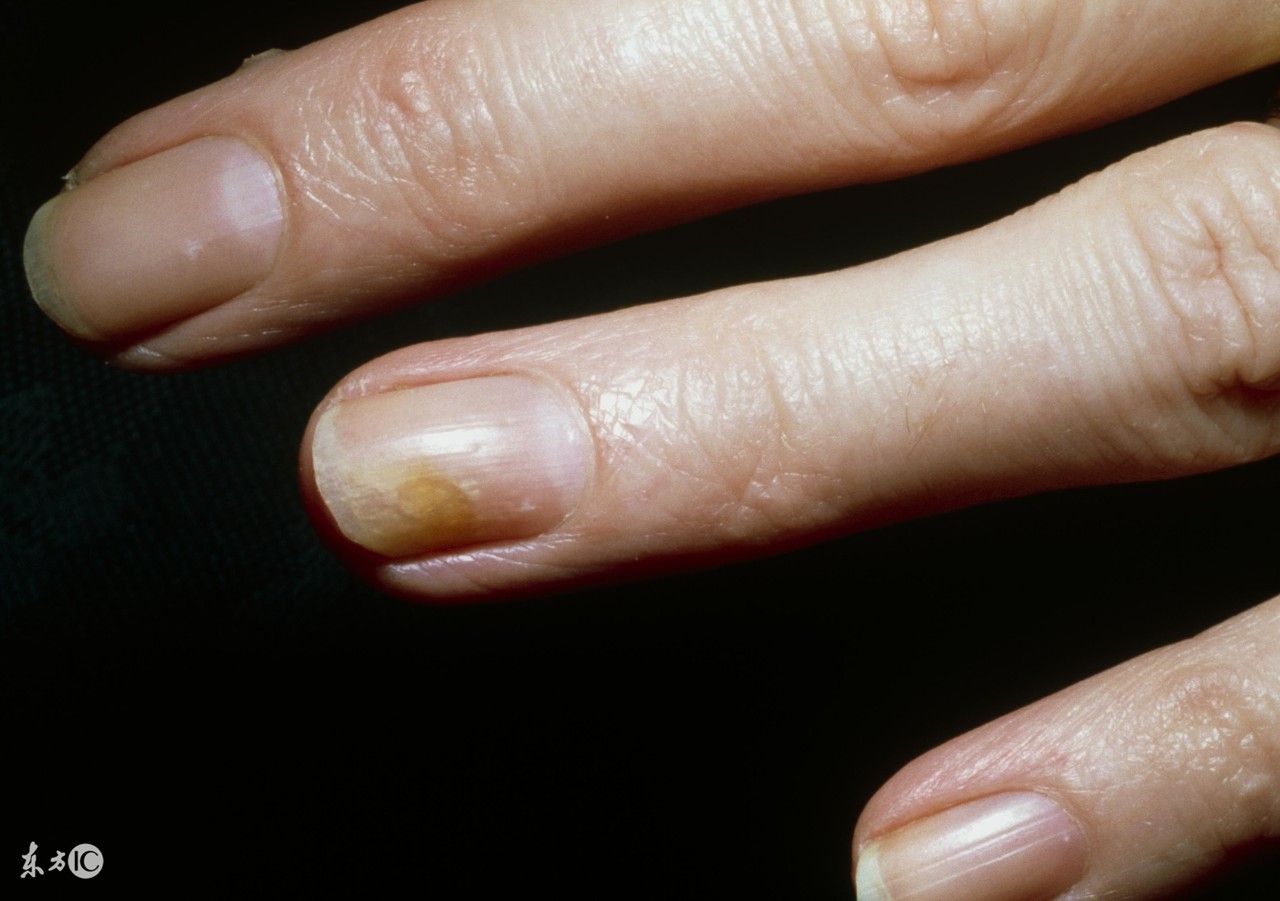 得了灰指甲不敢去医院,怎么样不被传染上灰指甲