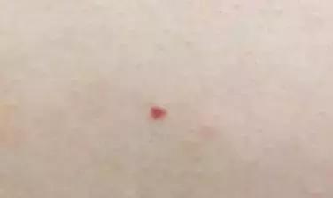60岁身上现小红痣是什么原因,身上出现小红痣是什么原因造成的