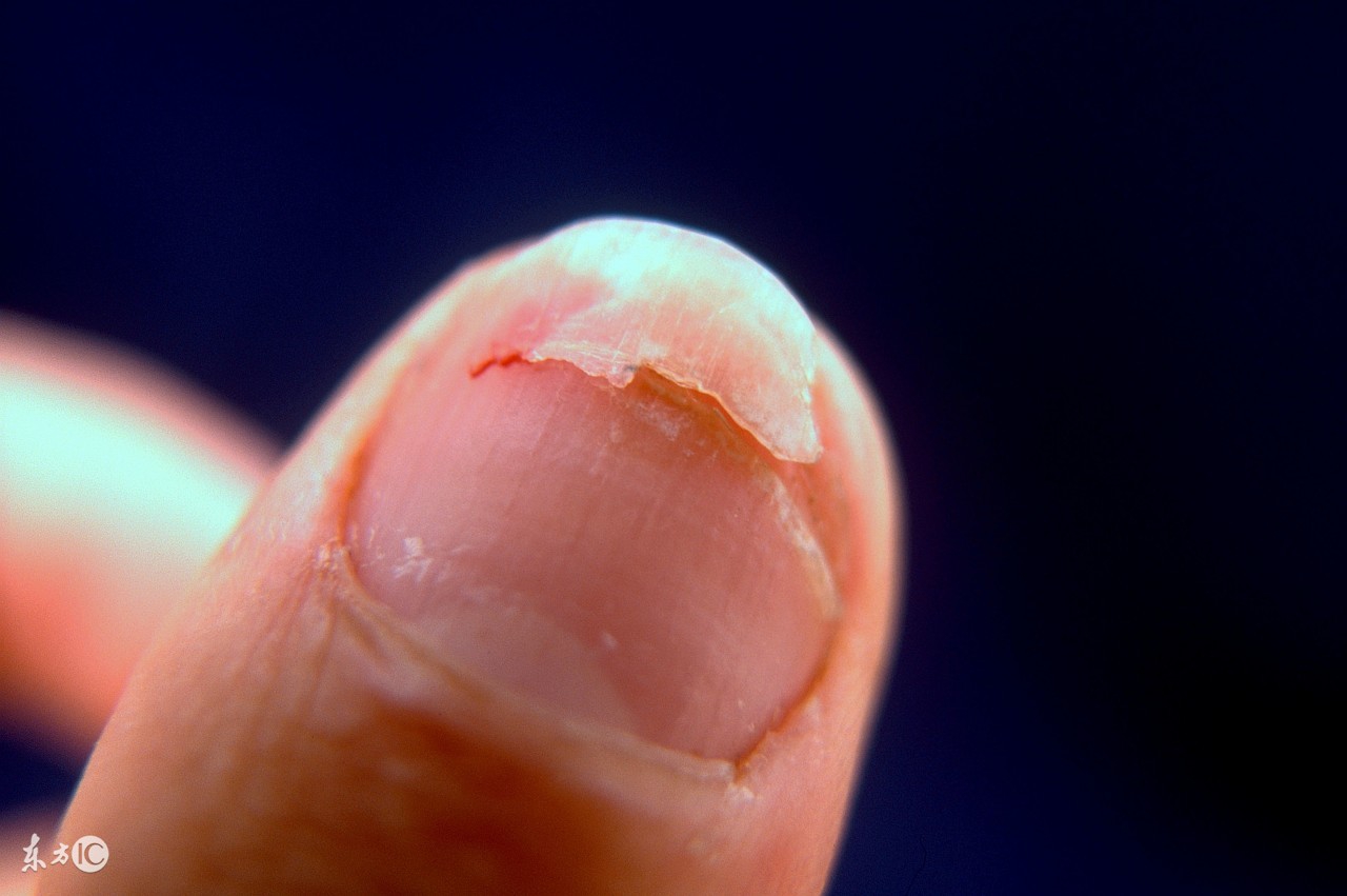 得了灰指甲不敢去医院,怎么样不被传染上灰指甲