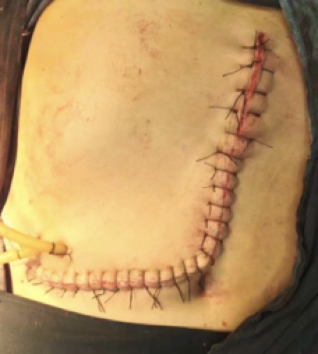 一带一路▪肿瘤微创健康中国行公益活动助肝癌患者重回健康