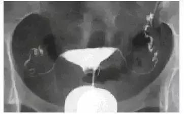 输卵管通不通，我该怎么查？