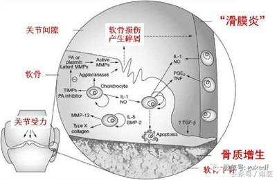 膝关节增生与滑膜炎的区别,关节炎滑膜炎骨质增生能治好吗