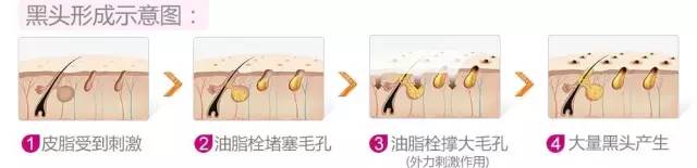 粉刺黑头去除最快方法,黑头虫怎么去除最快方法