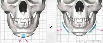 玻尿酸微整形丰下巴多少钱一针,下巴微整形要多少钱