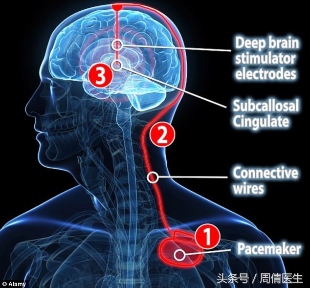 帕金森脑深部电刺激效果,脑深部电刺激dbs美国