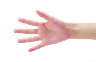 湿疹是怎么得的好了又复发,治湿疹最有效的植物