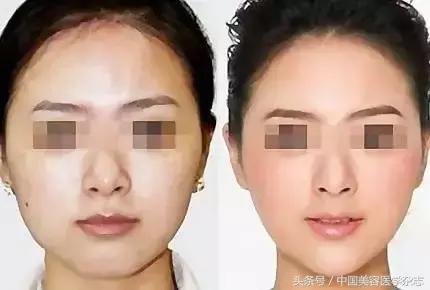 线雕面部提升女的,少女线雕术