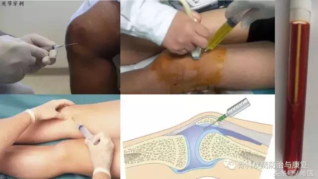 关节无名肿痛是什么原因引起的,关节肿痛无骨折