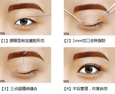 双眼皮原来这么简单自然无痕,做过的双眼皮如何看起来自然一些