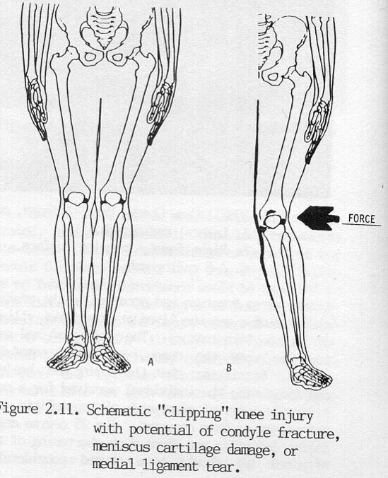 膝关节的急性损伤有哪些,膝关节侧韧带损伤症状