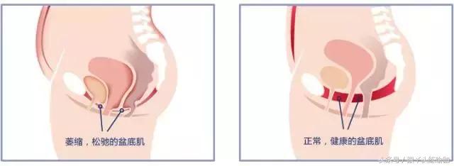 瑜伽怎么做才能改善盆底肌,瑜伽哪个动作可以改善盆底肌