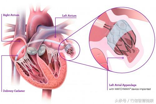房颤患者属于慢性病吗,房颤究竟是怎么得的